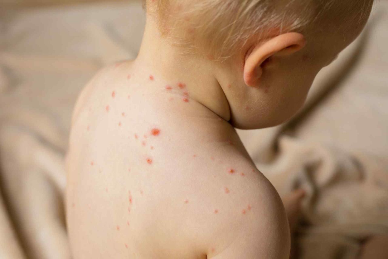 Progressive Joint Pain And Rash in Kids