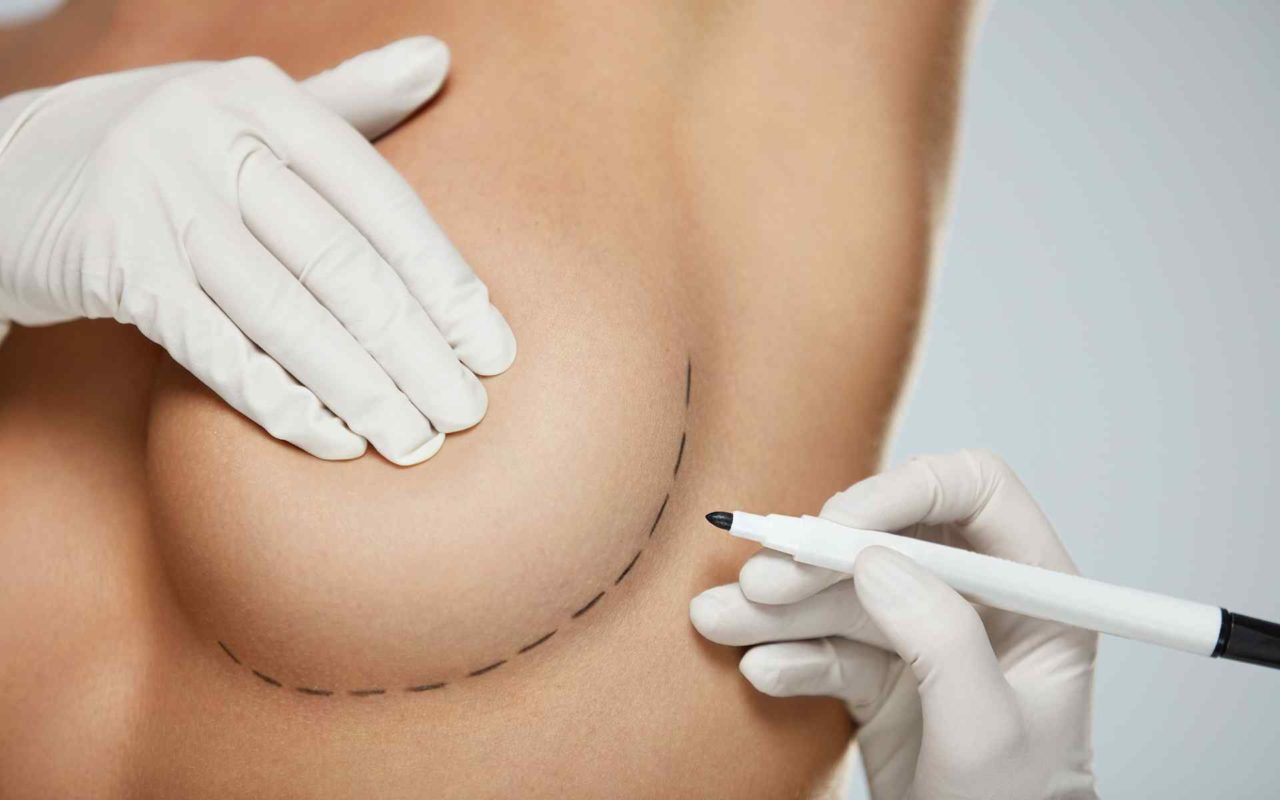 What to do After Breast Augmentation Surgery in Vivo